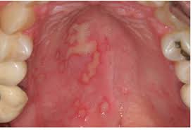 Image result for Oral herpes roof of mouth