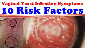 Featured in webmd · read our reviews now · 100% money back guarantee How Long Does A Yeast Infection Last Days Weeks Months Years Youtube