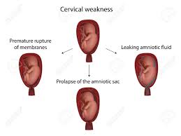 Check spelling or type a new query. Cervical Weakness Prolapse Of The Amniotic Sac Leaking Amniotic Stock Photo Picture And Royalty Free Image Image 141760253