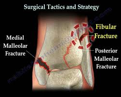 The lateral malleolus forms the lower extremity of the fibula. Ankle And Foot Fractures Physiopedia