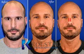 Both upper lateral cartilages are deviated. Spreader Graft Copy Dr Kolstad San Diego Facial Plastic Surgeon