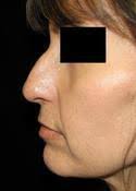 Non Surgical Nose Job • Osman Dermatology