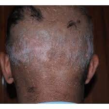 Vitiligo Patches On Scalp With White Hair Download Scientific Diagram