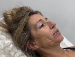 The New Carboxy Therapy Facial