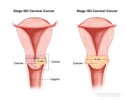 Such adenocarcinoma cells cause 20% of cervical cancers. Cervical Cancer Treatment Pdq Patient Version National Cancer Institute