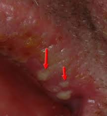 Image result for oral herpes symptoms roof of the mouth