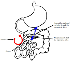 Image result for Midgut Volvulus