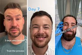 Inside the Rise of 'Brotox'