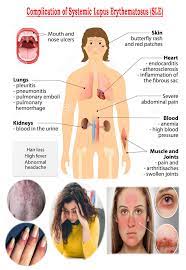 It is also referred to as discoid lupus erythematosus. Systemic Lupus Erythematosus Sle Medicoinfo Lupus Body Tissues Chronic Inflammation