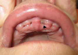 It is therefore not unusual that you wake up the next morning with a little blood in your mouth. Alveolar Osteitis Wikipedia