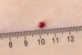 Image result for Pyogenic Granuloma