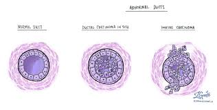 What is carcinoma in situ and what does it mean? Ductal Carcinoma In Situ Of The Breast Mypathologyreport Ca