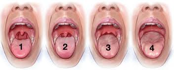 Hypertension evaluation exam night sweats trauma in pregnancy obstructive sleep apnea obstructive sleep apnea in children procedural sedation and analgesia advanced airway. Mallampati