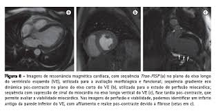 Saiba como é feito em casos de crianças e bebês. Jornal Brasileiro De Pneumologia Ressonancia Magnetica Do Torax Aplicacoes Tradicionais E Novas Com Enfase Em Pneumologia