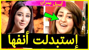 ظهور الندبات أو التشوّهات، وعدم اختفاء آثار العملية في بعض الأحيان، الأمر الذي. Ø£Ø³ÙŠÙ„ Ø¹Ù…Ø±Ø§Ù† ØªØµØ¯Ù… Ø¬Ù…Ù‡ÙˆØ±Ù‡Ø§ Ø¨Ø¹Ø¯ Ø§Ø³ØªØ¨Ø¯Ø§Ù„ Ø£Ù†ÙÙ‡Ø§ Ø¨Ø¹Ù…Ù„ÙŠØ© ØªØ¬Ù…ÙŠØ§ÙŠØ© Youtube