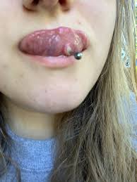 In this article why do you need to clean your baby's tongue? Bump After Tongue Piercing Thriftyfun