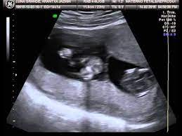 Ultrasonido Gemelos 13 Semanas 3 Youtube