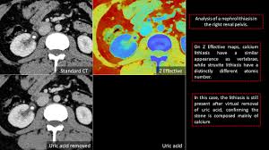 Image result for Calcium Nephrolithiasis