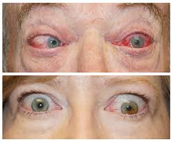 I don't think yours is the same. Crsteurope Managing Thyroid Eye Disease