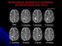 Si bien puede desarrollarse a cualquier edad. Tene Mos Y Quere Memos Diagnostico