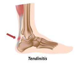 There is typically between 2 to 6 centimeters of the achilles tendon that. Mr Peter Ammon Chronic Achilles Tendon Problems Murdoch Orthopaedic Clinic