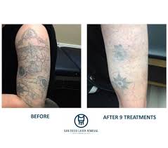 An affordable la / san diego laser tattoo removal clinic with over 200,000 laser treatments tattoos, on average, require six to eight or more treatments, with treatments usually spaced approximately four to eight weeks apart. Facebook
