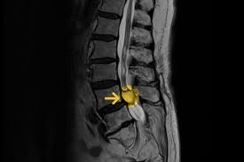 We did not find results for: Gelenkzyste Gemeinschaftspraxis Fur Neurochirurgie