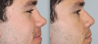 Facial Plastic Surgeon Orange County