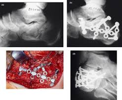 Image result for Calcaneus Compression Fracture