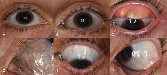 Image result for melanosis sclera