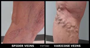 What is the best treatment for veins? Try These 4 Diy Tricks To Make Spider Veins Disappear