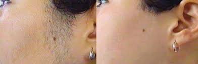 2017 fadianxiu aliexpress hair best hair color asian girl curl hair frizz ends hair dry frizzy great gatsby daisy hair hair in mumbai india no no hair removal. Laser Hair Removal Before And After Manchester Clear Medical