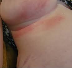 Image result for heat rash under breasts