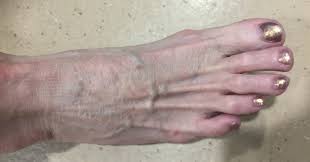 Nerve damage in the feet or poor blood flow to the feet increases the risk of various foot complications. Racgp Diabetic Foot Ulcer