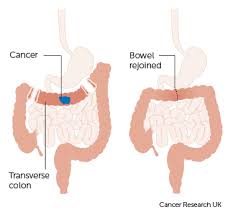 Transverse Colectomy Png Cancer Colon Cancer Colectomy