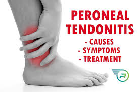 Most people don't know that the knee pain associated with the patellar tendon can be treated at today, we're going to talk about one specific type of knee pain — pain in the patellar tendon of your. Can You Treat Peroneal Tendonitis With Compression Socks Run Forever Sports