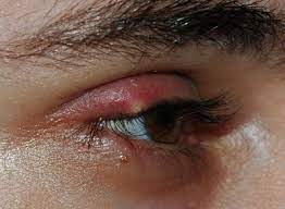 El Orzuelo Y El Chalacion Ocularis