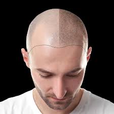 Quality that goes into scalp micropigmentation cost . Scalp Society Scalp Micropigmentation Bay Area Hawaii