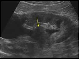 Renal cell carcinoma renal tumor renal mass renal cell cancer tumor thrombus. 16 Sonography Renal Cell Carcinoma Ideas Renal Cell Carcinoma Renal Sonography