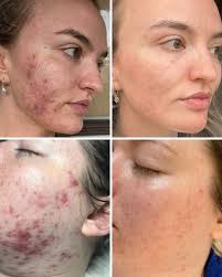We love building our clients' confidence back up and Dermalux LED  phototherapy allows us to do exactly that, especially those for whom acne  is a skin concern. Why use Dermalux to treat