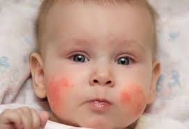 Image result for red rash face