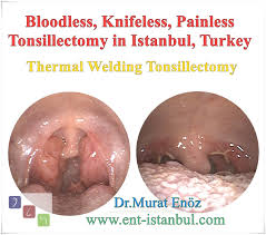 Tonsils are lumps of tissue on both sides of the back of the throat that help the immune system protect the body from infections. Health Zone Turkey Tonsillectomy Operation In Istanbul Turkey