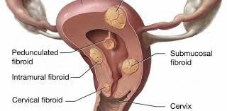 A woman can have many uterine fibroids of different sizes. 5 Signs You Might Have Uterine Fibroids Vm Med