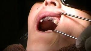 Looking to get full upper teeth extracted then dentures … read more. Extraction Lateral Incisor Upper Anterior Physics Forceps Overdenture Full Mouth Extractions Youtube