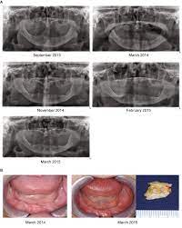 Program within @mayoclinicgradschool is currently accepting applications! Medication Related Osteonecrosis Of The Jaw Prevention Diagnosis And Management In Patients With Cancer And Bone Metastases Sciencedirect
