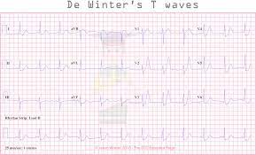 Patient:innen mit solchen ekgs und passender symptomatik brauchen potentiell dringend eine herzkatheteruntersuchung. De Winter S T Waves Acute Sign Of Proximal Lad Occlusion Grepmed