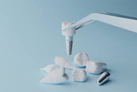 Federal grants for dental implants scam. Dental Implants Clinic In Grant Road South Mumbai
