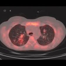 Contrast CT scan of the neck showing a thrombus in the left jugular...