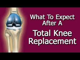 Top 3 Secrets For Increasing Knee Bend Total Knee Arthroplasty Youtube Total Knee Replacement Knee Arthroplasty Knee Replacement Exercises