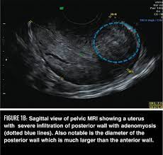 Adenomyosis And Its Impact On Fertility